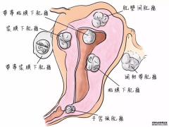 Hello IVF：子宫肌瘤要做试管需要先做手术吗？